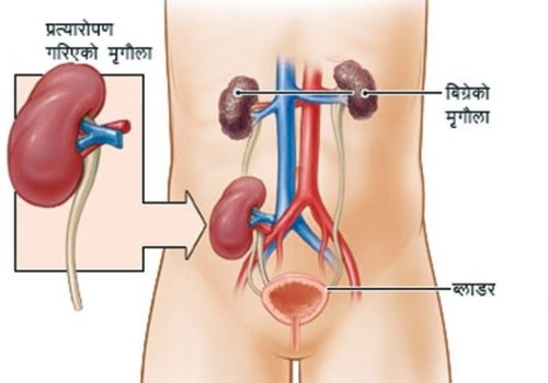 अवैध रुपमा मिर्गौला प्रत्यारोपण आरोपमा चितवनबाट दुई चिकित्सकसहित चार पक्राउ